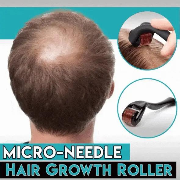 540 Needle Derma Roller – Micro Needle Roller for Hair Growth & Skin Care
